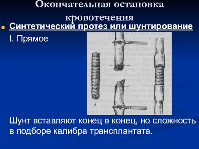 Окончательная остановка кровотечения Синтетический протез или шунтирование I. Прямое Шунт вставляют