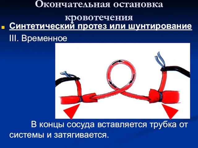 Окончательная остановка кровотечения Синтетический протез или шунтирование III. Временное В концы