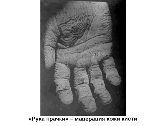 «Рука прачки» – мацерация кожи кисти