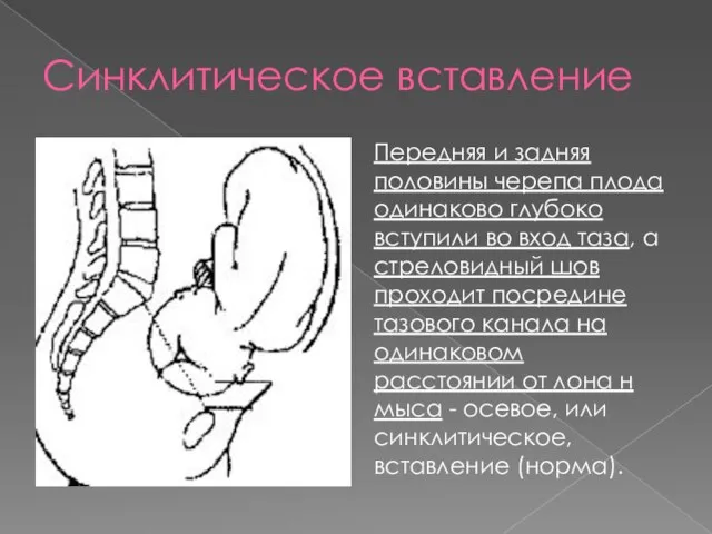 Синклитическое вставление Передняя и задняя половины черепа плода одинаково глубоко вступили