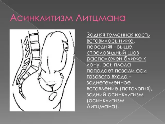 Асинклитизм Литцмана Задняя теменная кость вставилась ниже, передняя - выше, стреловидный