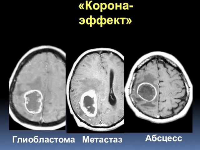 Глиобластома Метастаз Абсцесс «Корона-эффект»