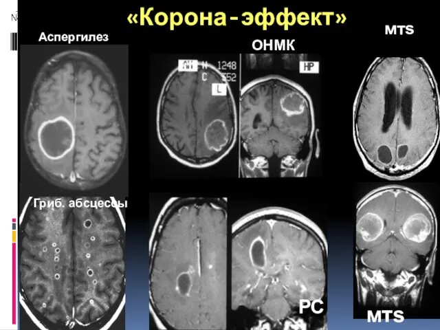 «Корона-эффект» Аспергилез РС мтs Гриб. абсцессы ОНМК мтs