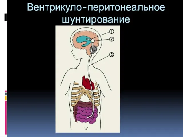 Вентрикуло-перитонеальное шунтирование