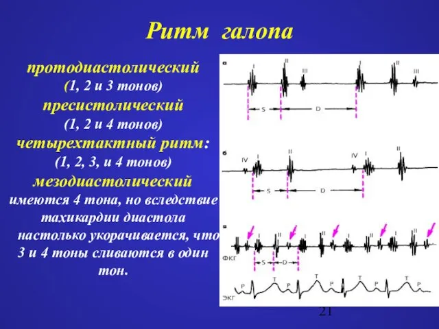 Ритм галопа протодиастолический (1, 2 и 3 тонов) пресистолический (1, 2