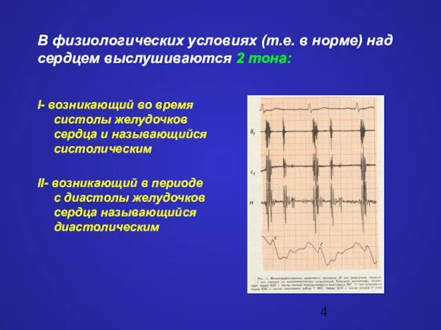 В физиологических условиях (т.е. в норме) над сердцем выслушиваются 2 тона: