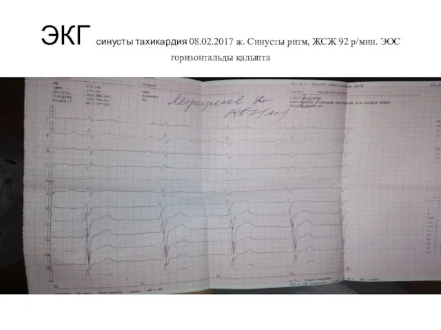 ЭКГ синусты тахикардия 08.02.2017 ж. Синусты ритм, ЖСЖ 92 р/мин. ЭОС горизонтальды қалыпта
