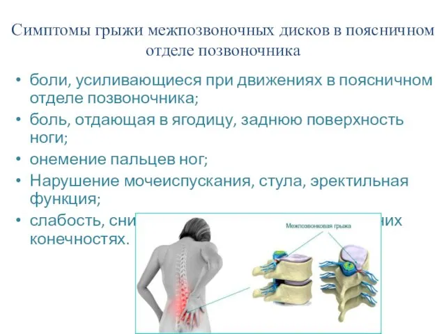 Симптомы грыжи межпозвоночных дисков в поясничном отделе позвоночника боли, усиливающиеся при