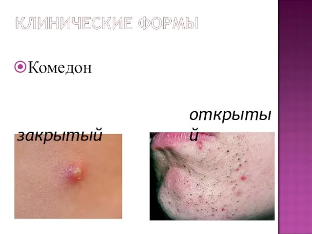 Комедон закрытый открытый