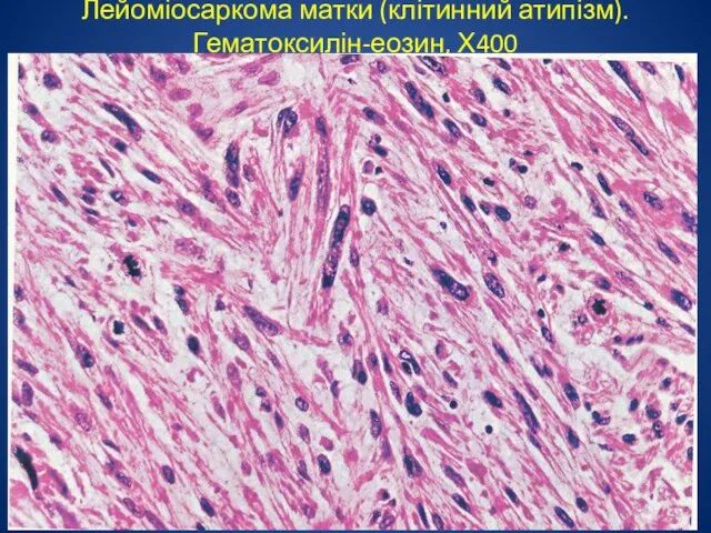 Лейоміосаркома матки (клітинний атипізм). Гематоксилін-еозин, Х400