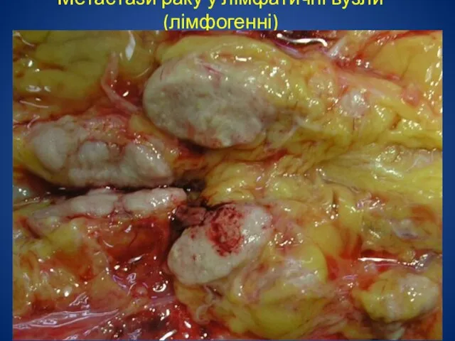 Метастази раку у лімфатичні вузли (лімфогенні)