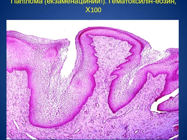 Папілома (екзаменаційний!). Гематоксилін-еозин, Х100