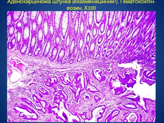 Аденокарцинома шлунка (екзаменаційний!). Гематоксилін-еозин, Х100