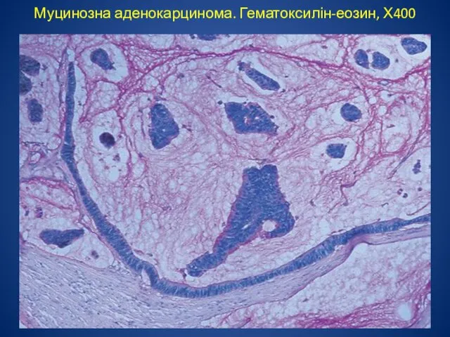 Муцинозна аденокарцинома. Гематоксилін-еозин, Х400