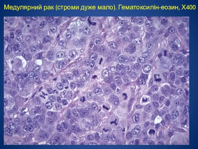 Медулярний рак (строми дуже мало). Гематоксилін-еозин, Х400