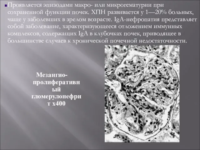 Мезангио-пролиферативный гломерулонефрит х400 Проявляется эпизодами макро- или микрогематурии при сохраненной функции