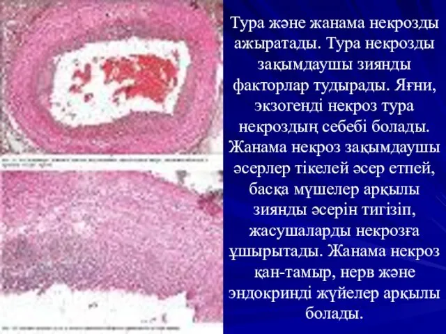 Тура және жанама некрозды ажыратады. Тура некрозды зақымдаушы зиянды факторлар тудырады.