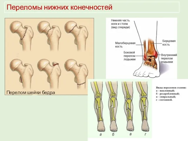 Переломы нижних конечностей Перелом шейки бедра