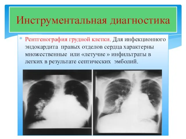 Рентгенография грудной клетки. Для инфекционного эндокардита правых отделов сердца характерны множественные