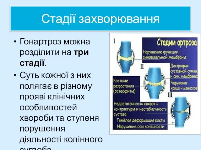 Стадії захворювання Гонартроз можна розділити на три стадії. Суть кожної з