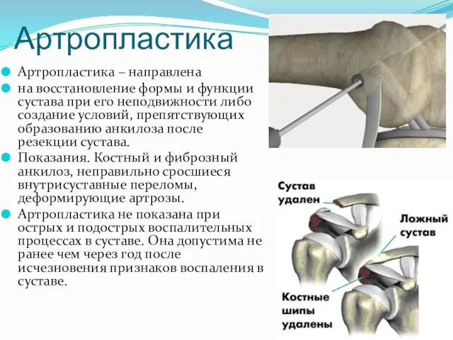 Артропластика Артропластика – направлена на восстановление формы и функции сустава при