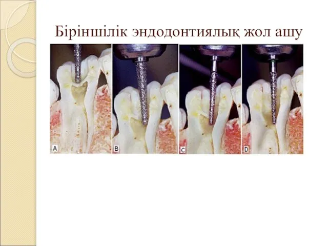 Біріншілік эндодонтиялық жол ашу