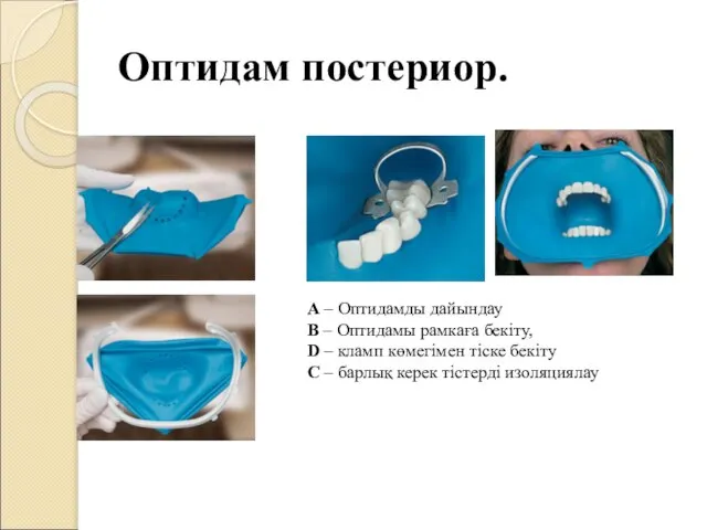 Оптидам постериор. А – Оптидамды дайындау B – Оптидамы рамкаға бекіту,