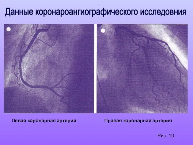 Рис. 10 Данные коронароангиографического исследовния Левая коронарная артерия Правая коронарная артерия