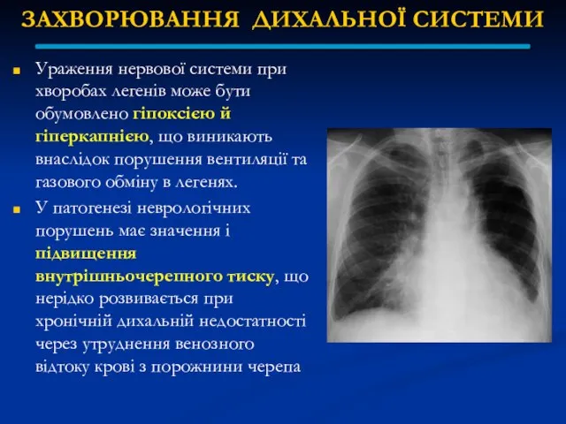 ЗАХВОРЮВАННЯ ДИХАЛЬНОЇ СИСТЕМИ Ураження нервової системи при хворобах легенів може бути