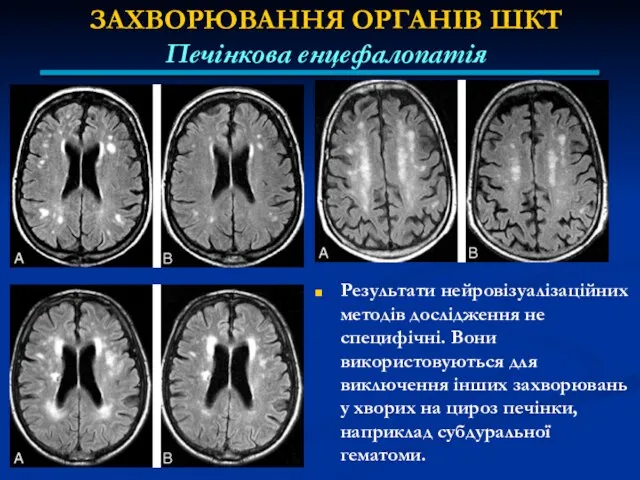 ЗАХВОРЮВАННЯ ОРГАНІВ ШКТ Печінкова енцефалопатія Результати нейровізуалізаційних методів дослідження не специфічні.