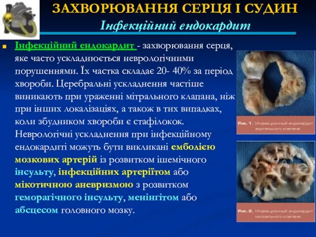 ЗАХВОРЮВАННЯ СЕРЦЯ І СУДИН Інфекційний ендокардит Інфекційний ендокардит - захворювання серця,