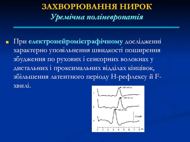 ЗАХВОРЮВАННЯ НИРОК Уремічна поліневропатія При електронейромієграфічному дослідженні характерно уповільнення швидкості поширення