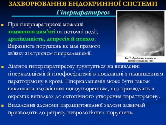 ЗАХВОРЮВАННЯ ЕНДОКРИННОЇ СИСТЕМИ Гіперпаратиреоз Діагноз гиперпаратиреозу ґрунтується на виявленні гіперкальціємії й