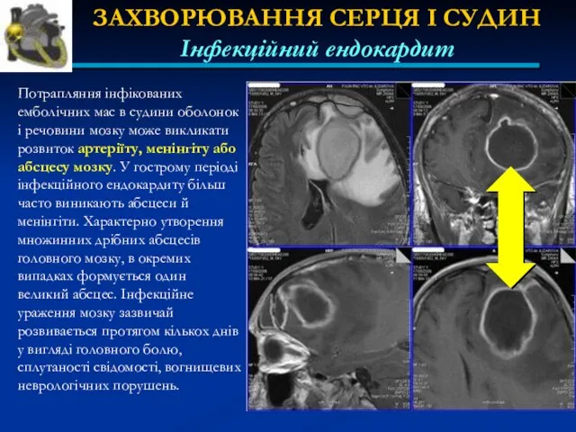 ЗАХВОРЮВАННЯ СЕРЦЯ І СУДИН Інфекційний ендокардит Потрапляння інфікованих емболічних мас в