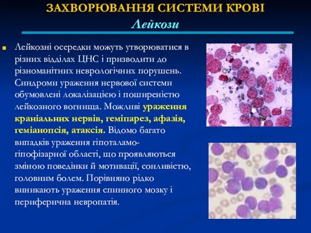 ЗАХВОРЮВАННЯ СИСТЕМИ КРОВІ Лейкози Лейкозні осередки можуть утворюватися в різних відділах