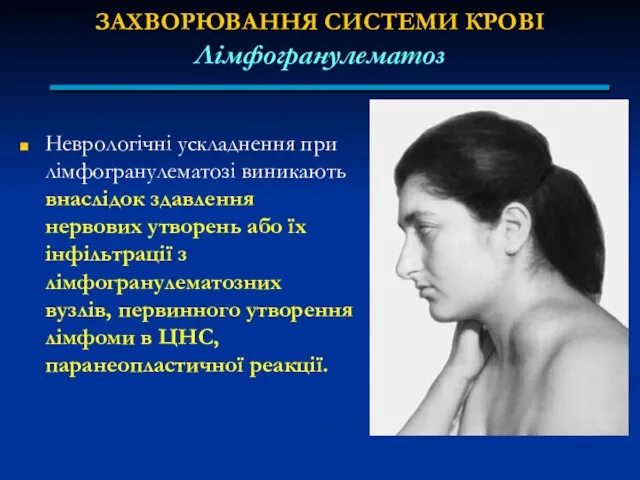 ЗАХВОРЮВАННЯ СИСТЕМИ КРОВІ Лімфогранулематоз Неврологічні ускладнення при лімфогранулематозі виникають внаслідок здавлення