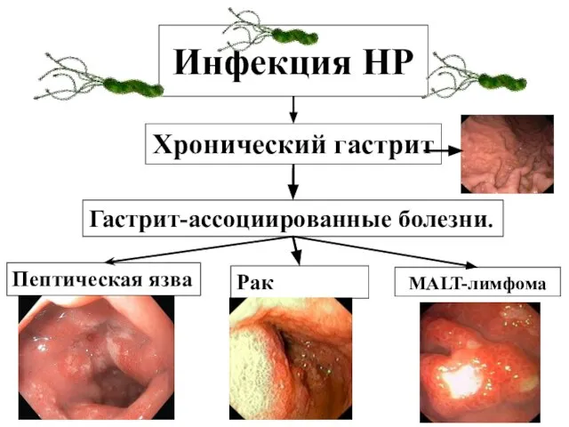 Инфекция НР Хронический гастрит Пептическая язва Рак желудка MALT-лимфома Гастрит-аcсоциированные болезни.