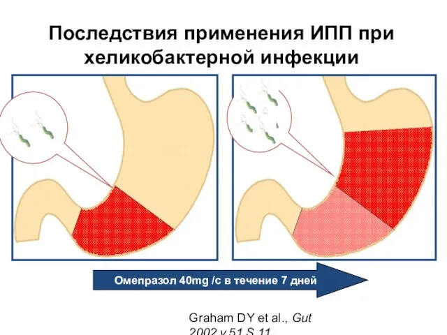 Последствия применения ИПП при хеликобактерной инфекции Graham DY et al., Gut