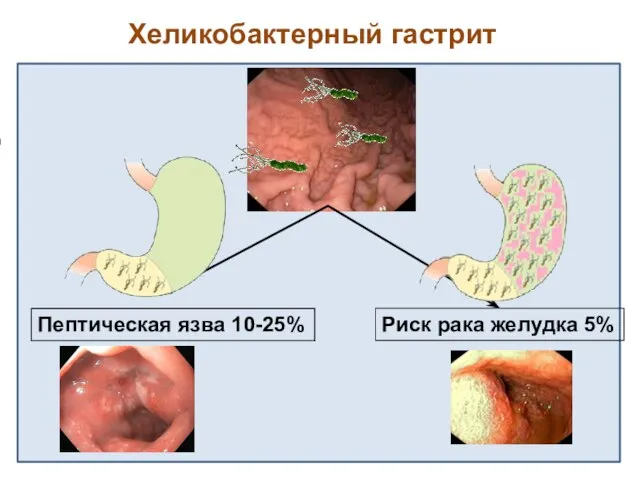 Хеликобактерный гастрит Пептическая язва 10-25% Риск рака желудка 5%