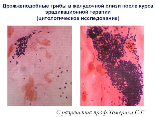 Дрожжеподобные грибы в желудочной слизи после курса эрадикационной терапии (цитологическое исследование) С разрешения проф.Хомерики С.Г.
