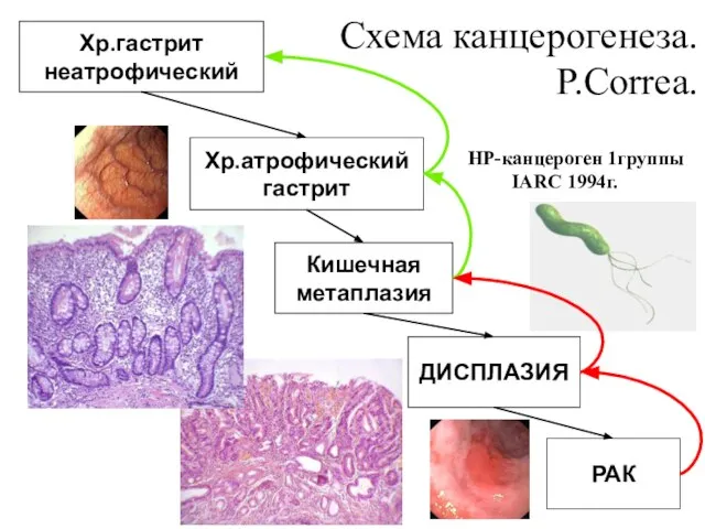 Хр.гастрит неатрофический Хр.атрофический гастрит Кишечная метаплазия ДИСПЛАЗИЯ РАК Схема канцерогенеза. P.Correa. НР-канцероген 1группы IARC 1994г.