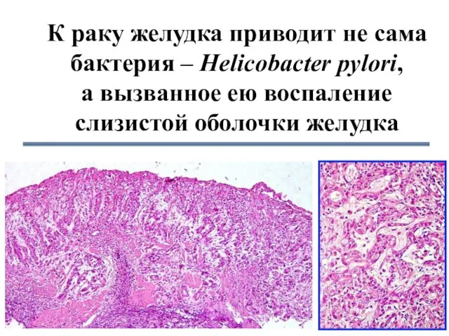 К раку желудка приводит не сама бактерия – Helicobacter pylori, а