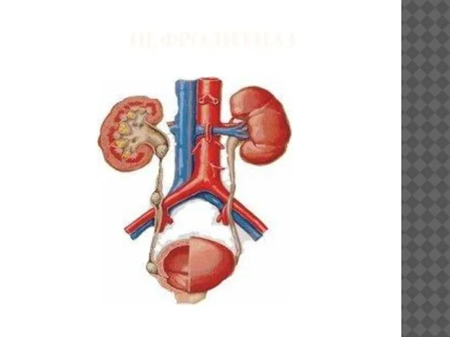 НЕФРОЛИТИАЗ