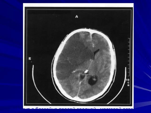 Инфаркт в бассейне правой средней мозговой артерии