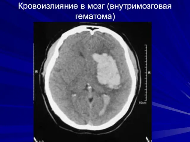 Кровоизлияние в мозг (внутримозговая гематома)