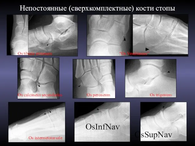 Непостоянные (сверхкомплектные) кости стопы Os tibiale externum Os peroneum Os calcaneus