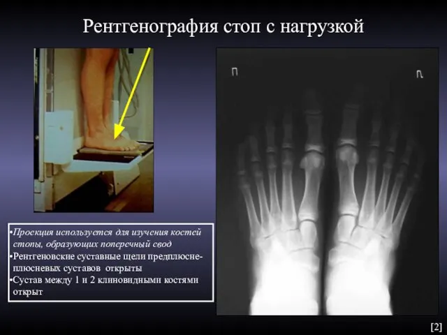 Рентгенография стоп с нагрузкой Проекция используется для изучения костей стопы, образующих