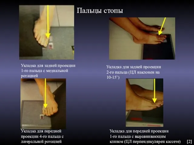 Укладка для задней проекции 1-го пальца с медиальной ротацией Укладка для