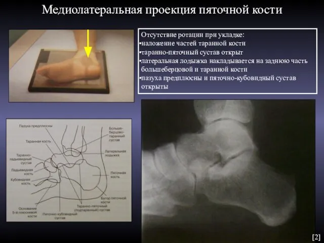 Медиолатеральная проекция пяточной кости Отсутствие ротации при укладке: наложение частей таранной