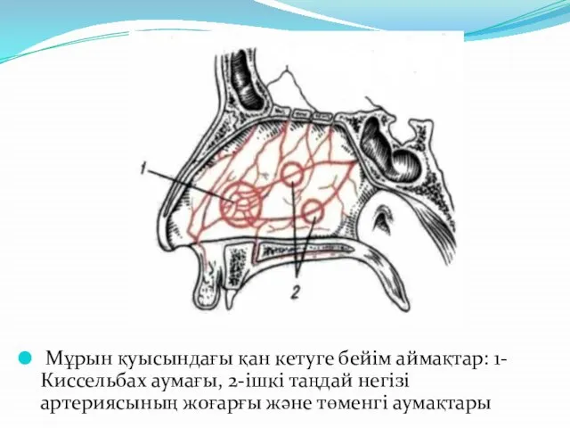 Мұрын қуысындағы қан кетуге бейім аймақтар: 1-Киссельбах аумағы, 2-ішкі таңдай негізі артериясының жоғарғы және төменгі аумақтары